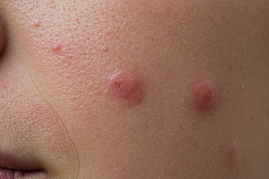 از بین بردن جوش برای همیشه